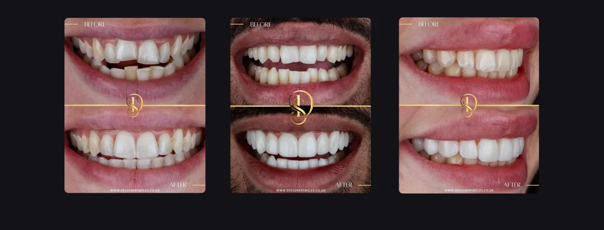 Designer Smiles before and after smile transformations