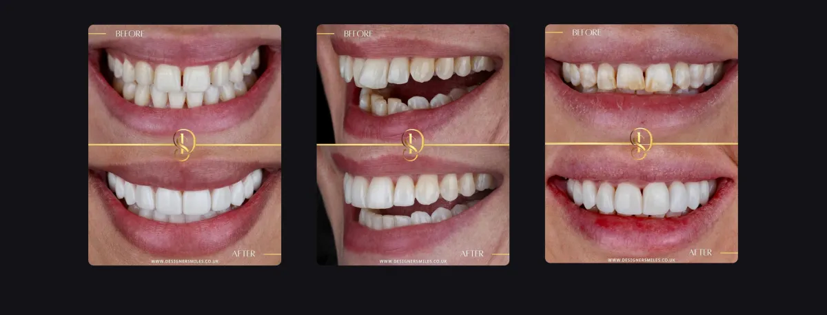 Designer Smiles before and after smile transformations
