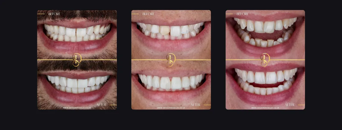 Designer Smiles before and after smile transformations