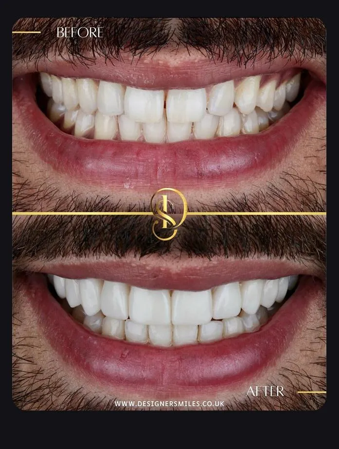Designer Smiles before and after smile transformation