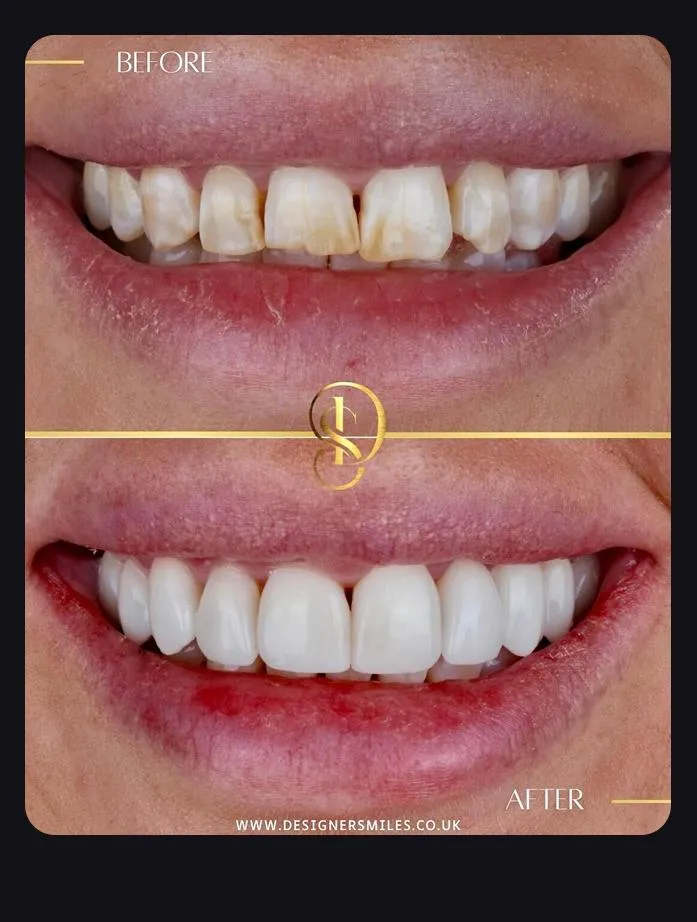 Designer Smiles before and after smile transformation