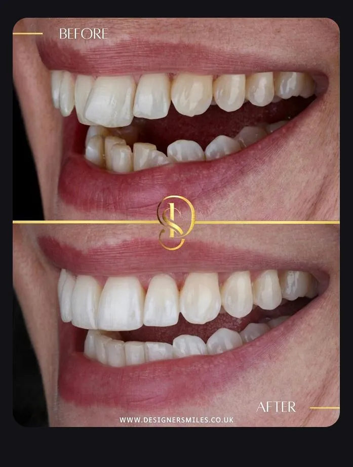 Designer Smiles before and after smile transformation