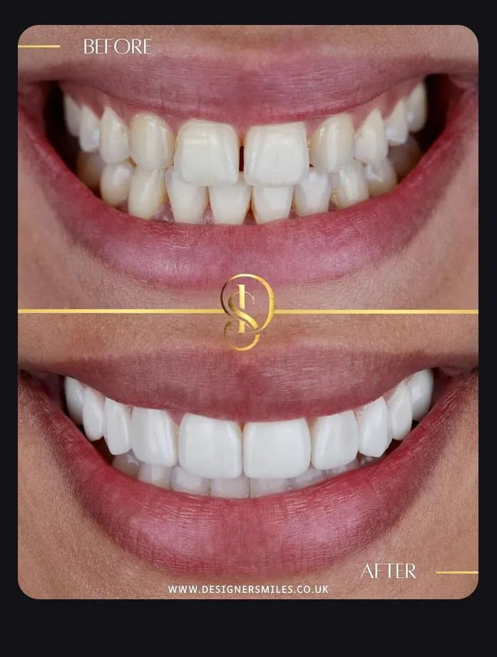Designer Smiles before and after smile transformation