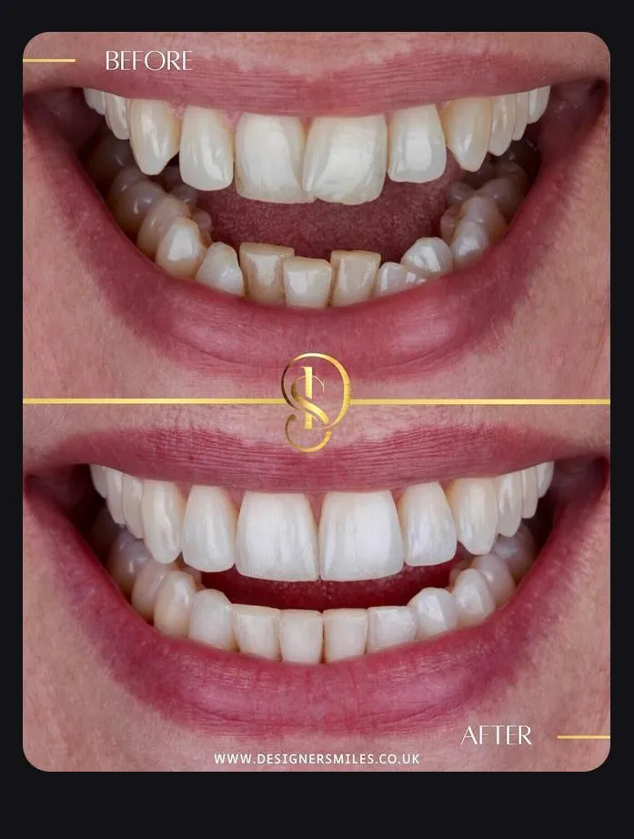 Designer Smiles before and after smile transformation