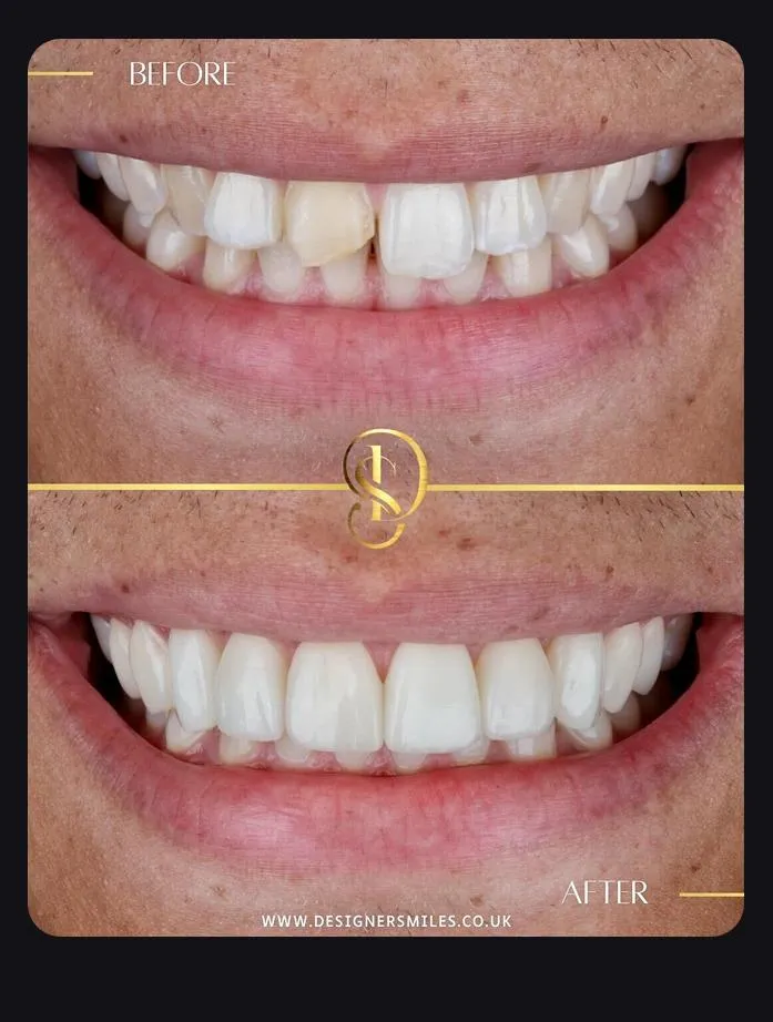 Designer Smiles before and after smile transformation