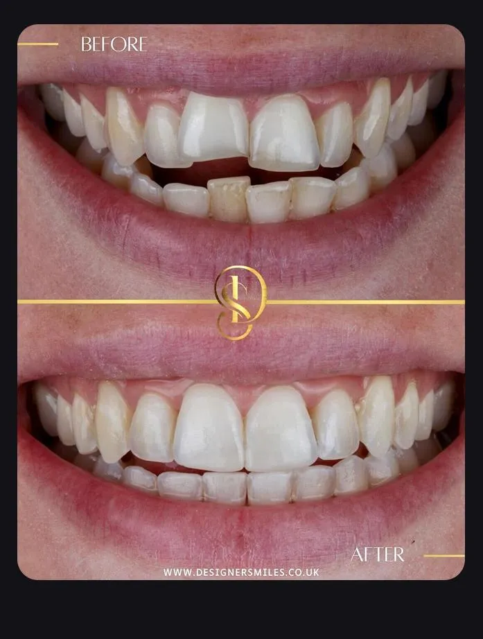 Designer Smiles before and after smile transformation