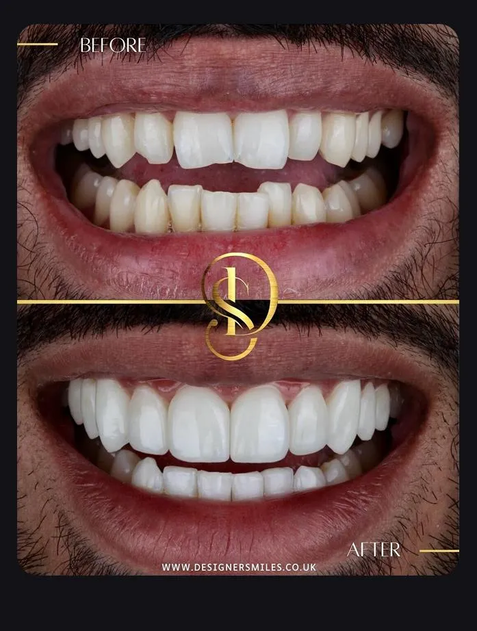 Designer Smiles before and after smile transformation