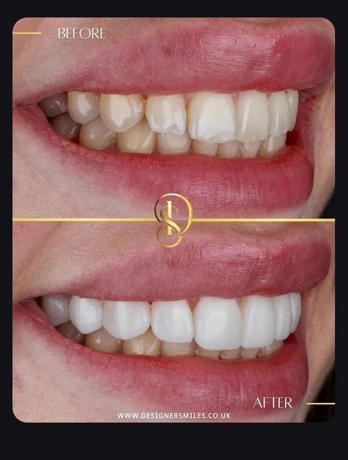 Designer Smiles before and after smile transformation