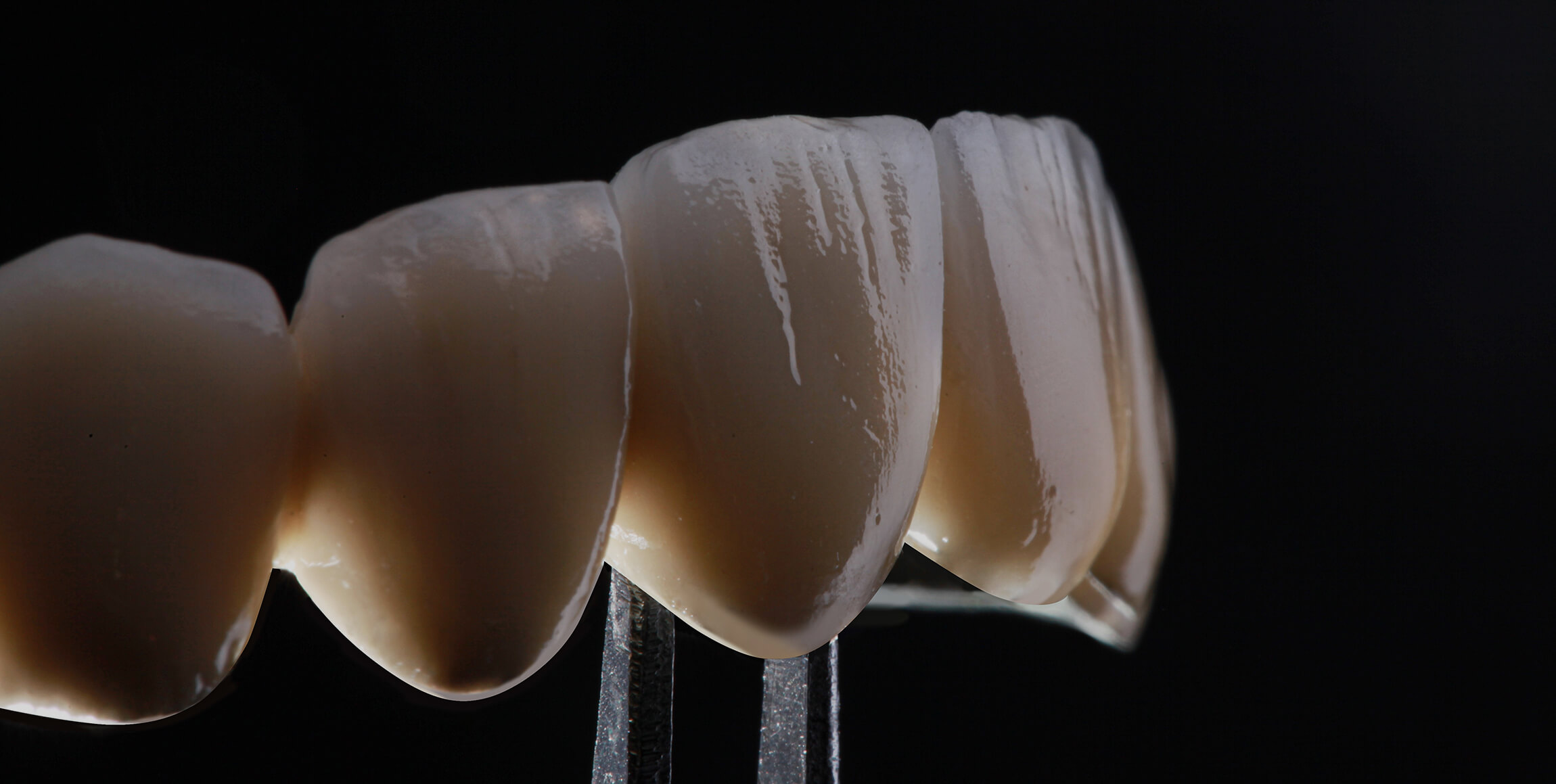 Is it time to replace your veneers?