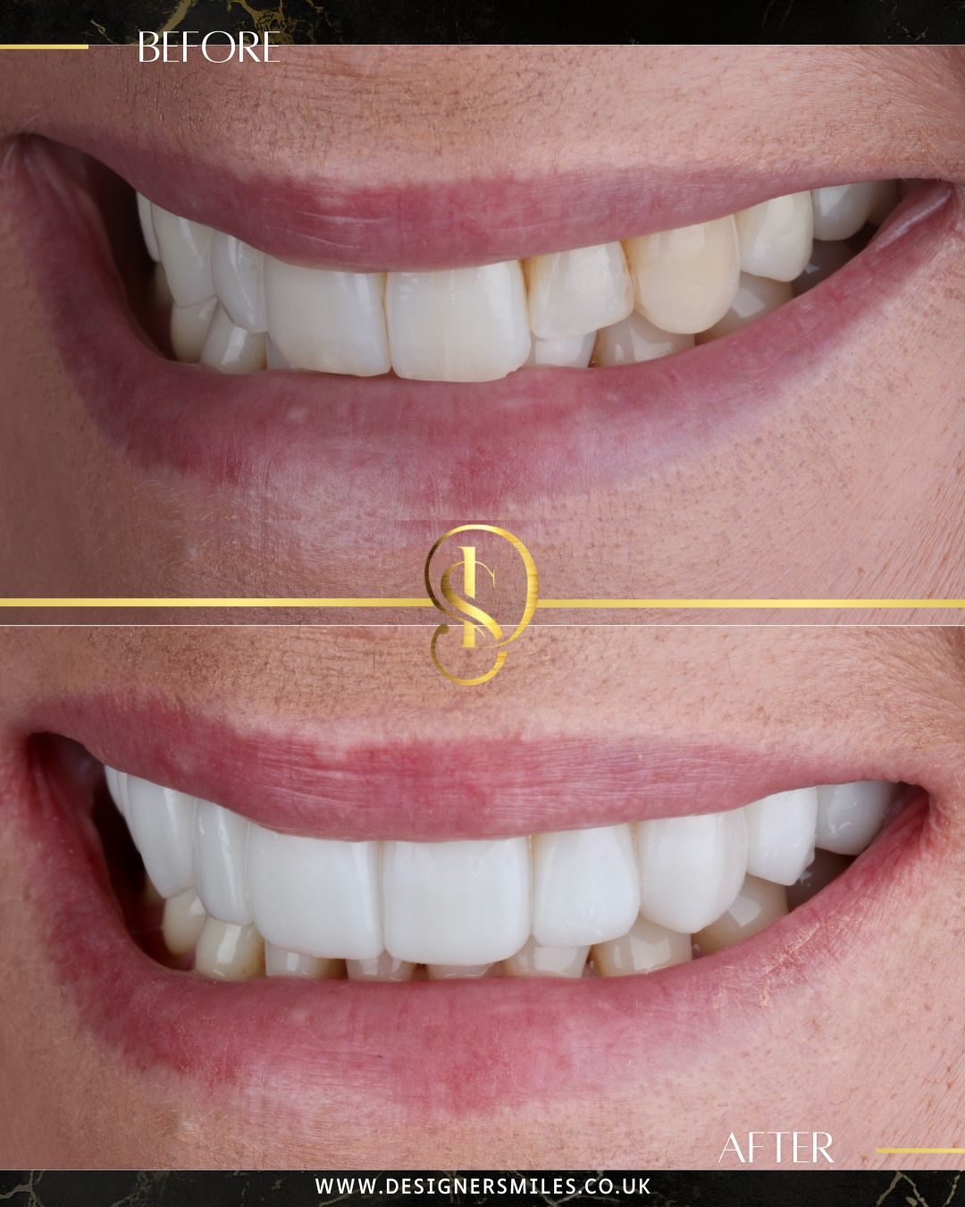 3D composite bonding at Designer Smiles, before and after