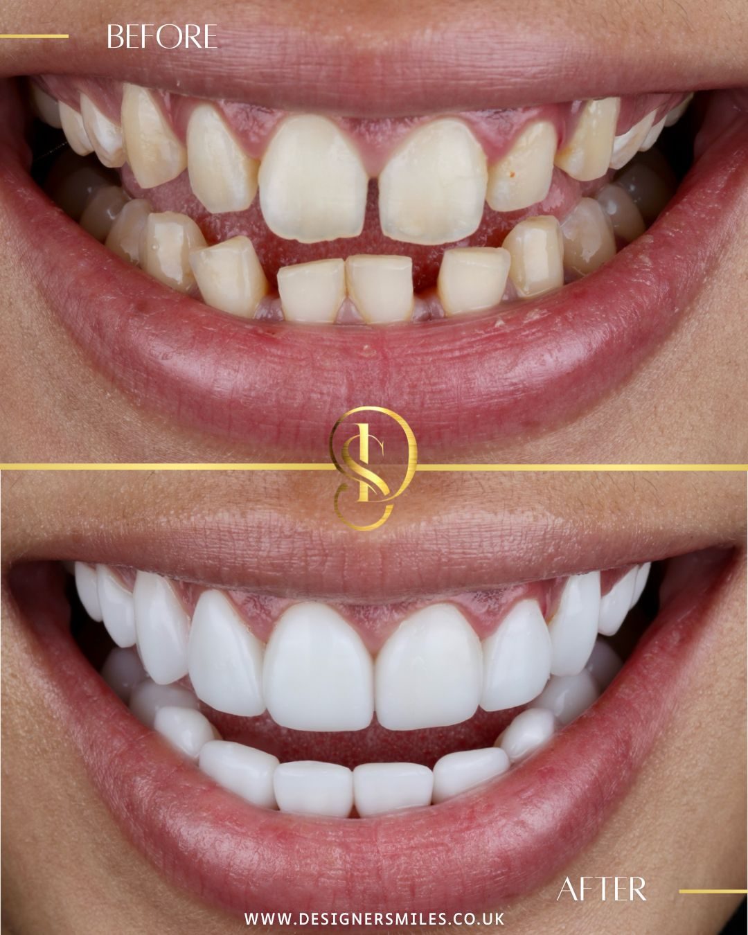 3D composite bonding at Designer Smiles, before and after