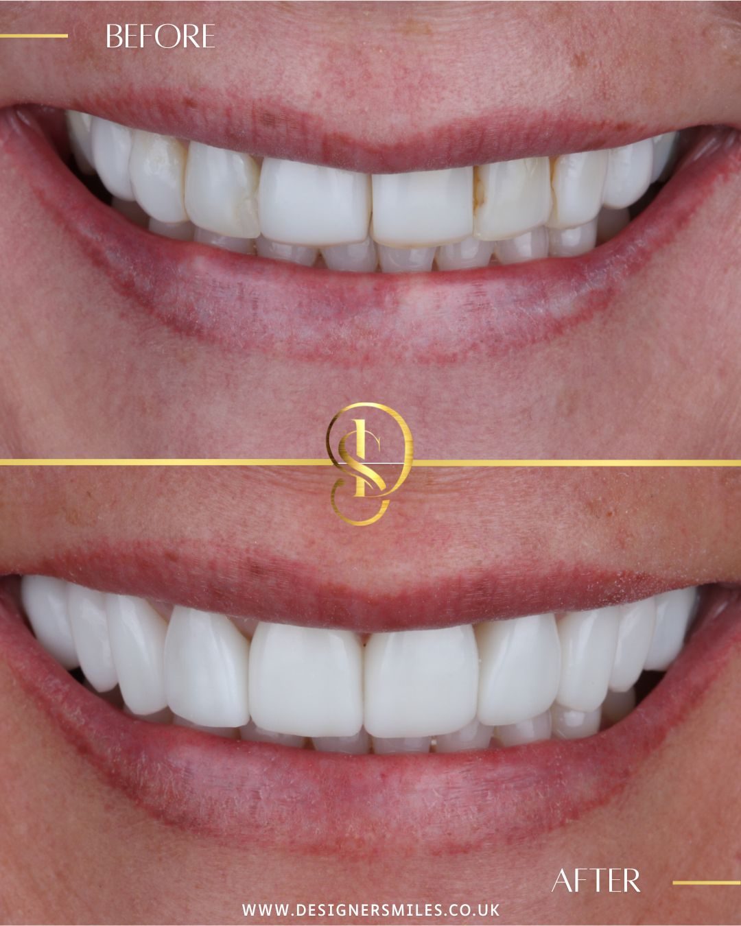 3D composite bonding at Designer Smiles, before and after