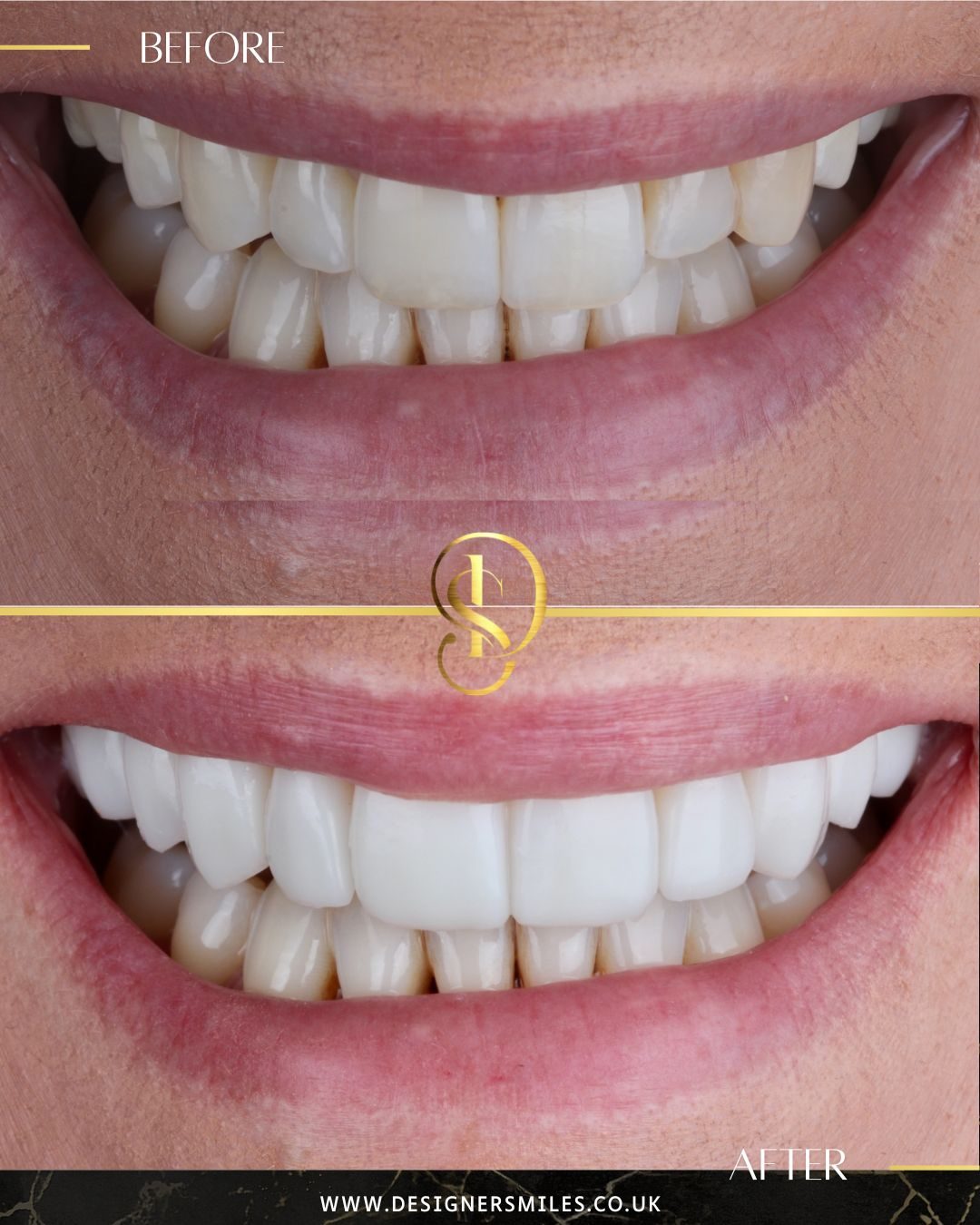 3D composite bonding at Designer Smiles, before and after