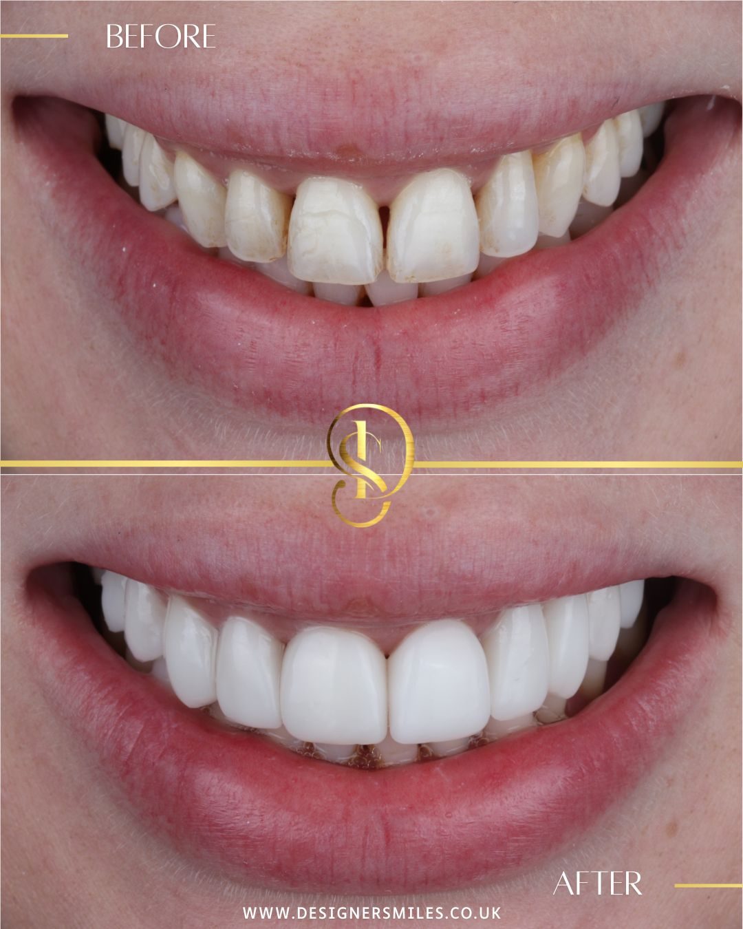 3D composite bonding at Designer Smiles, before and after