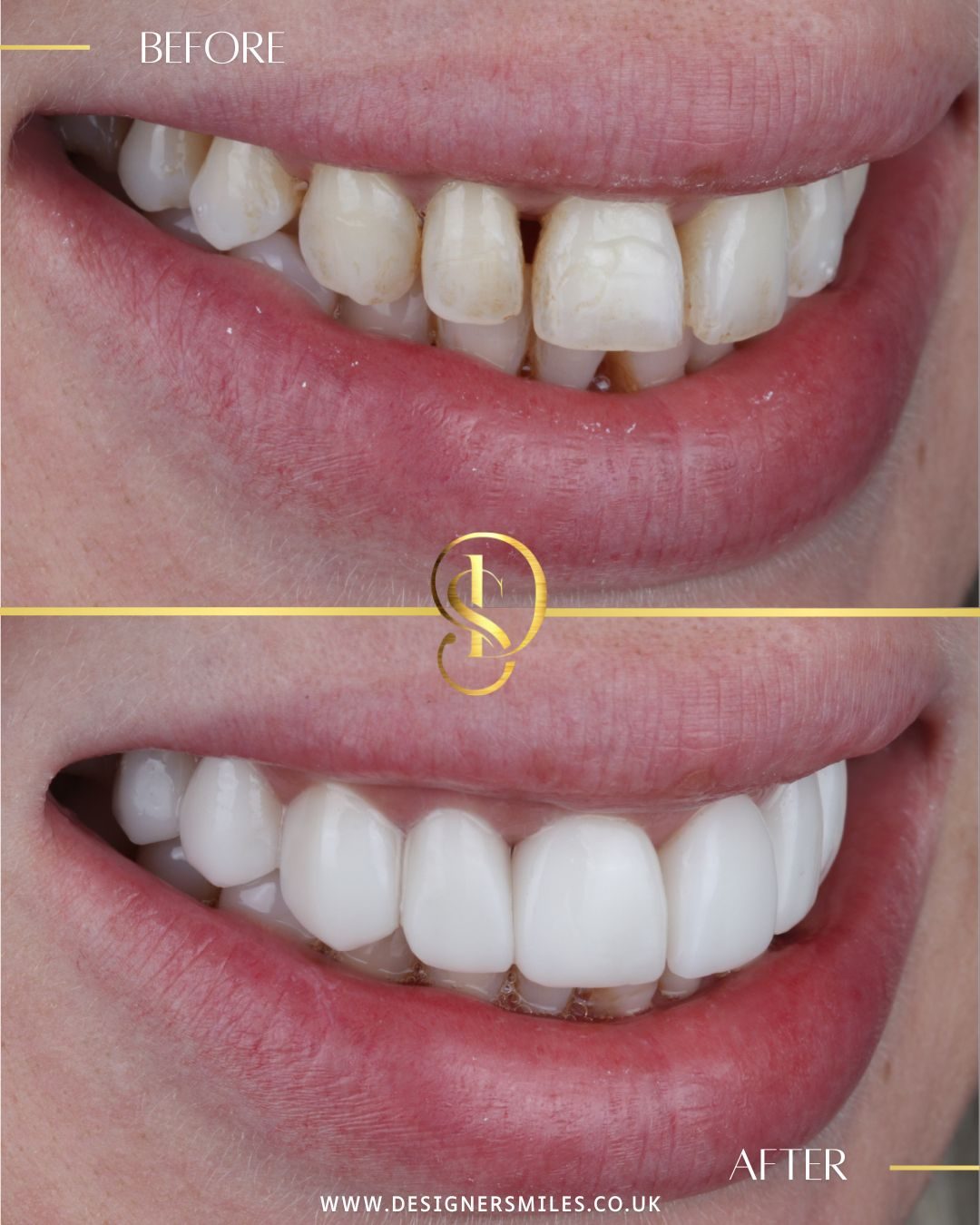 3D composite bonding at Designer Smiles, before and after