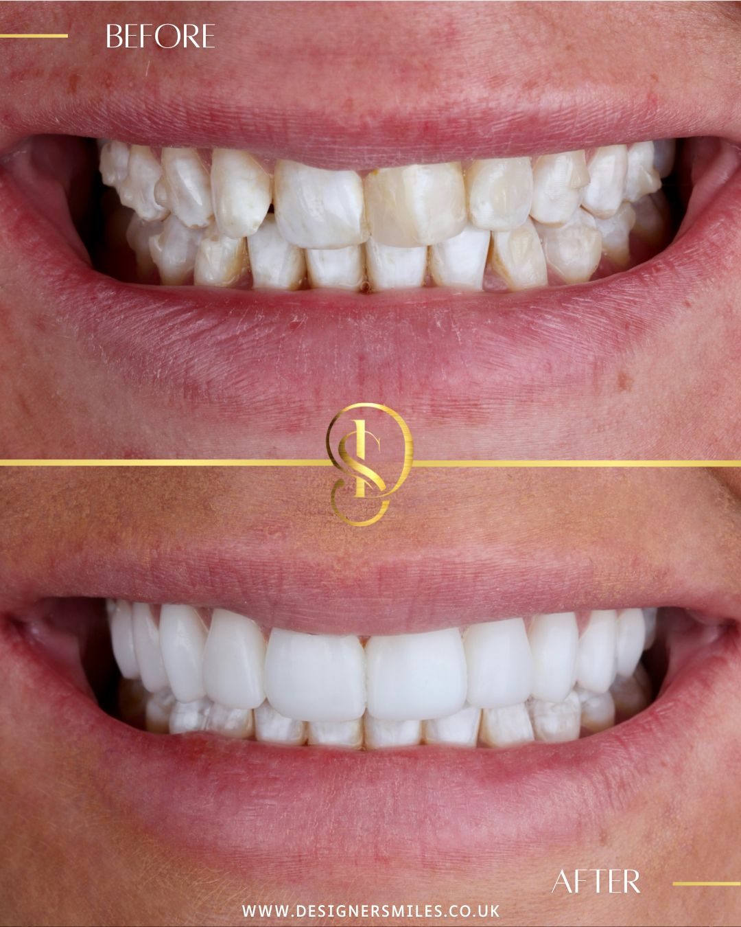 3D composite bonding at Designer Smiles, before and after