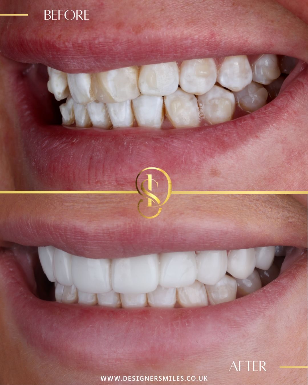 3D composite bonding at Designer Smiles, before and after