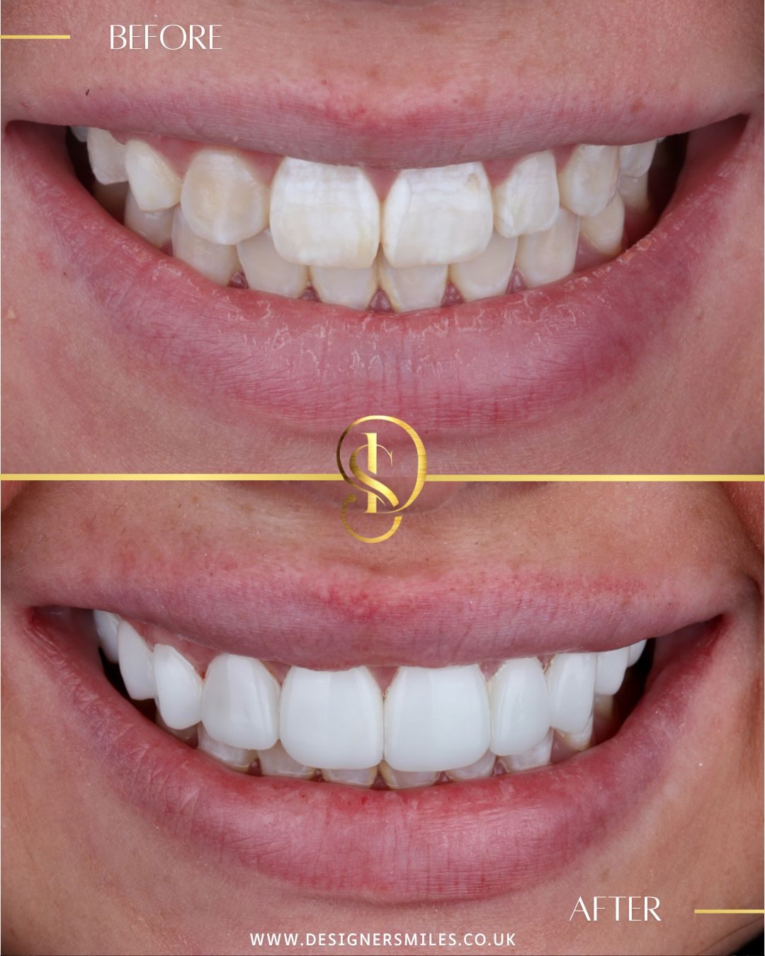 3D composite bonding at Designer Smiles, before and after