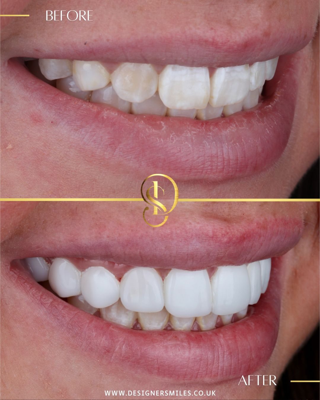 3D composite bonding at Designer Smiles, before and after