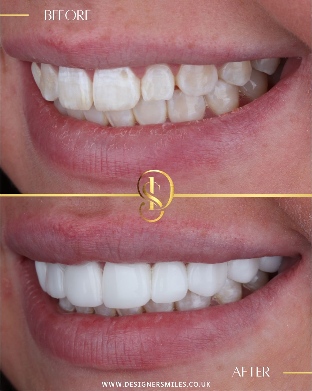 3D composite bonding at Designer Smiles, before and after