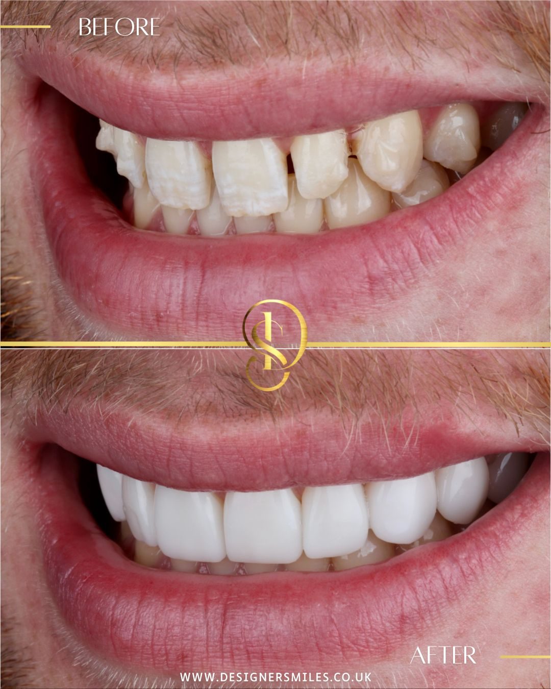 3D composite bonding at Designer Smiles, before and after