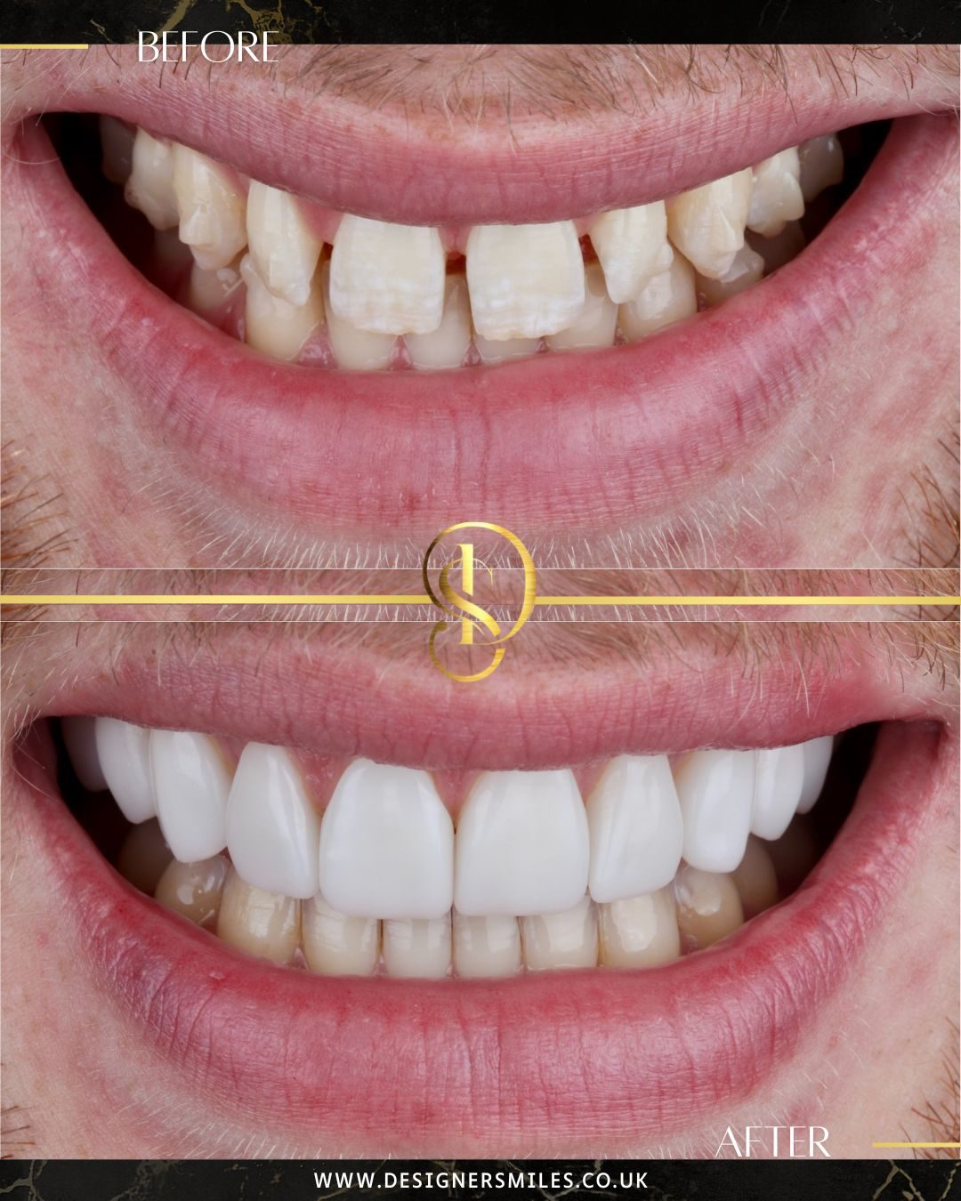 3D composite bonding at Designer Smiles, before and after