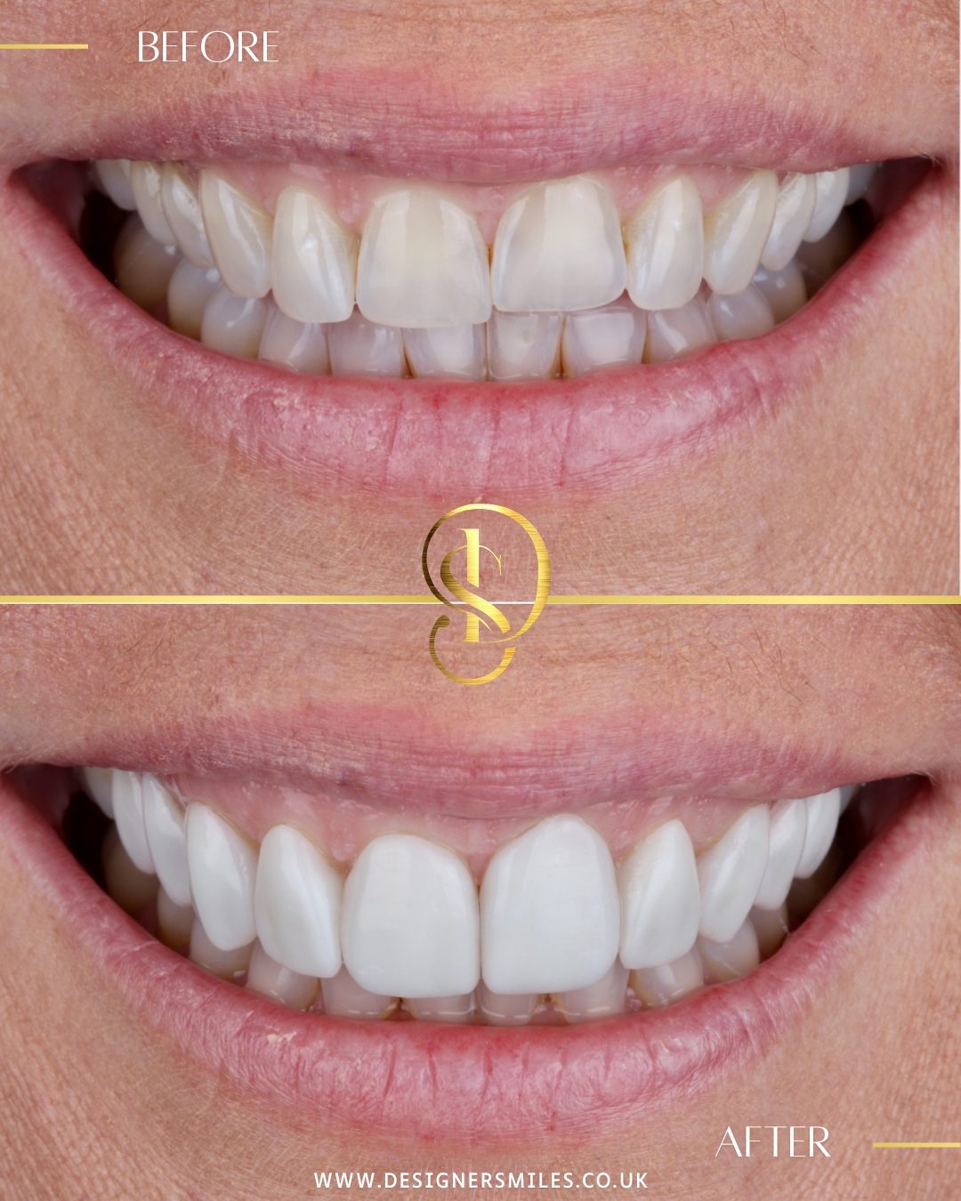 3D composite bonding at Designer Smiles, before and after
