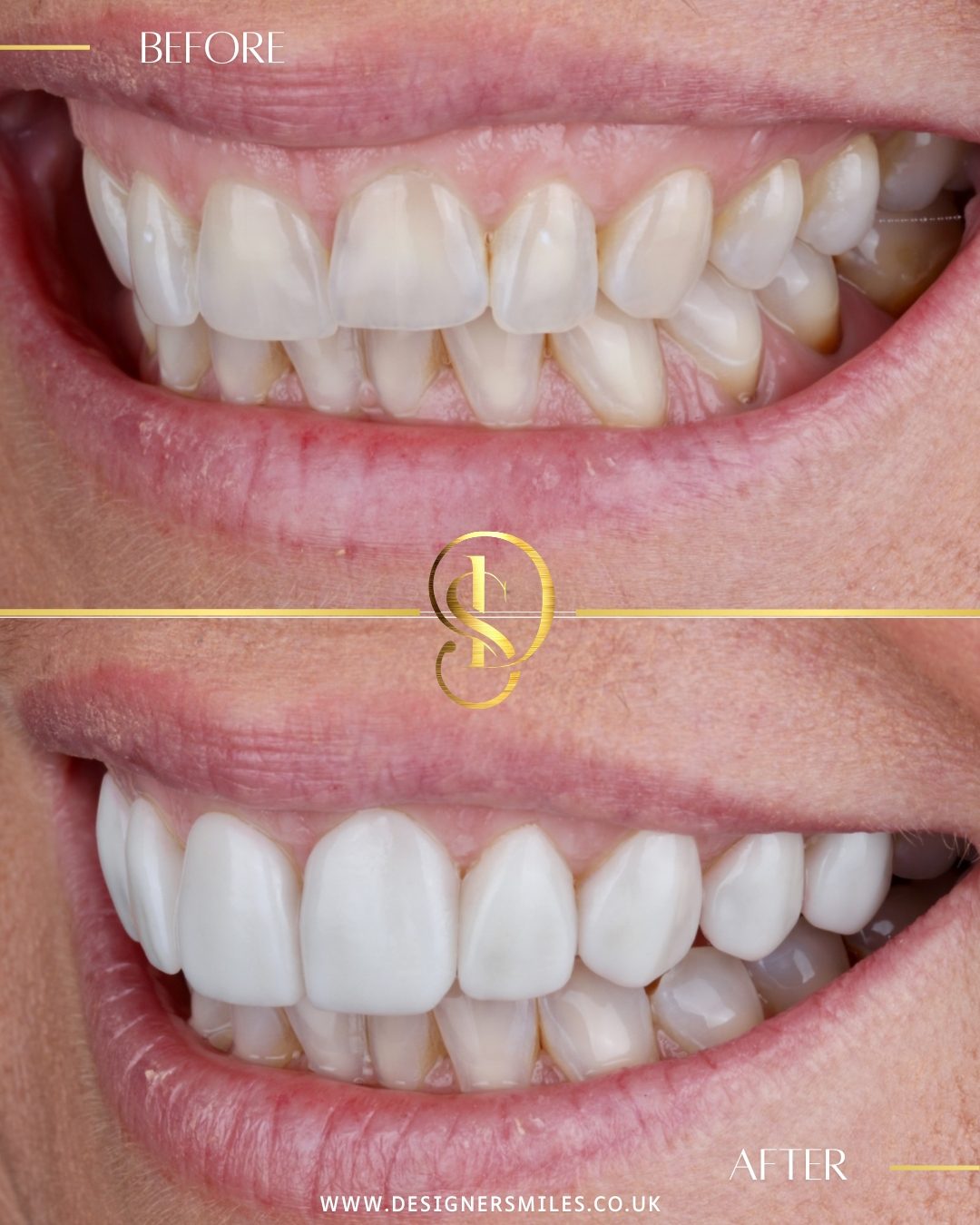 3D composite bonding at Designer Smiles, before and after