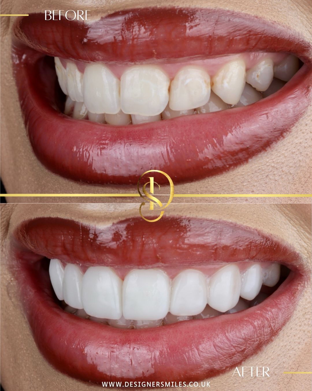 3D composite bonding at Designer Smiles, before and after