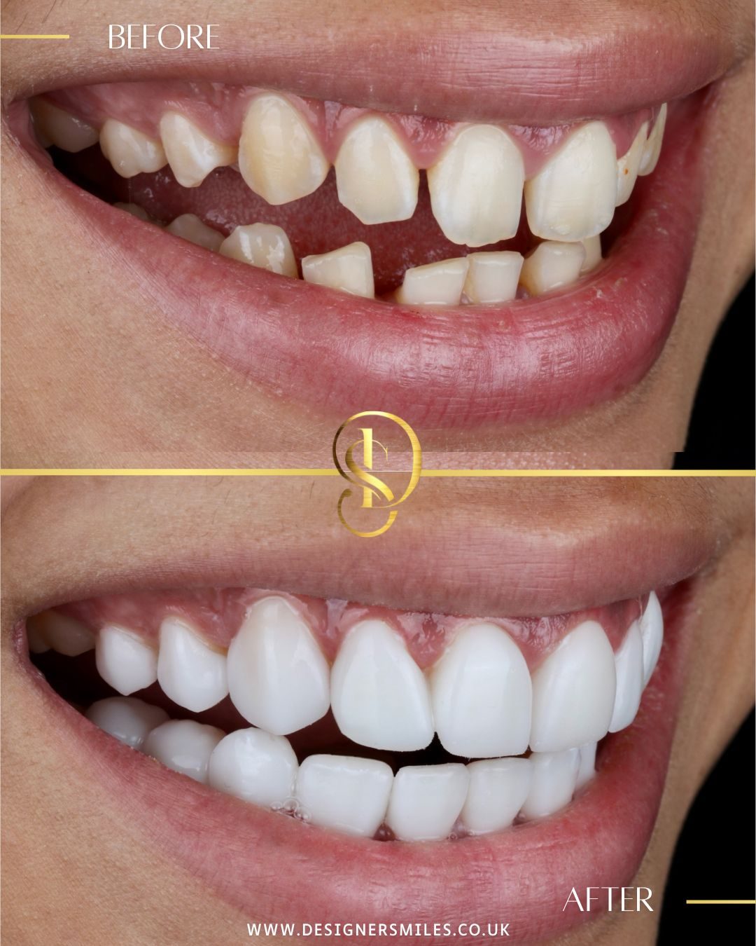 3D composite bonding at Designer Smiles, before and after