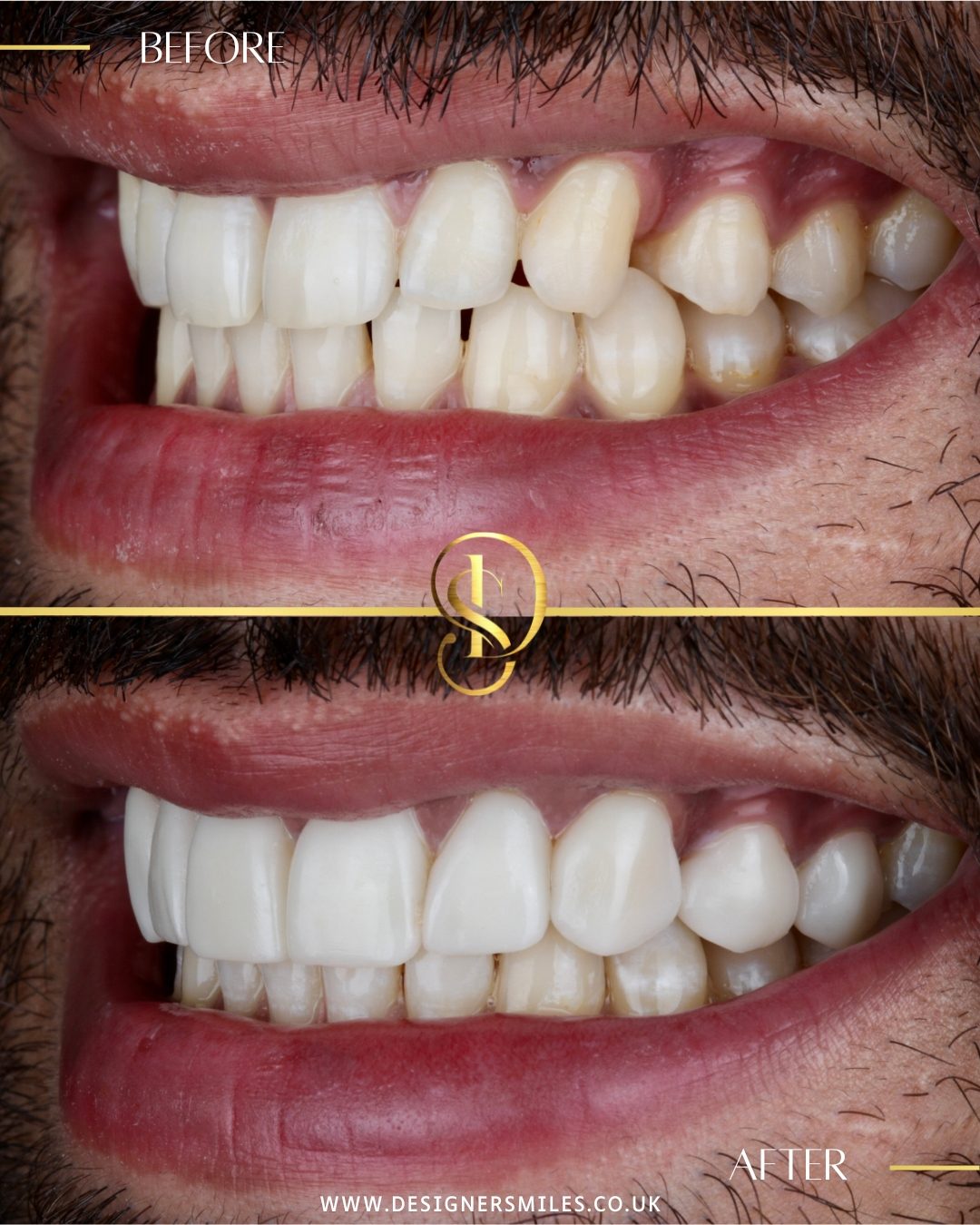 3D composite bonding at Designer Smiles, before and after