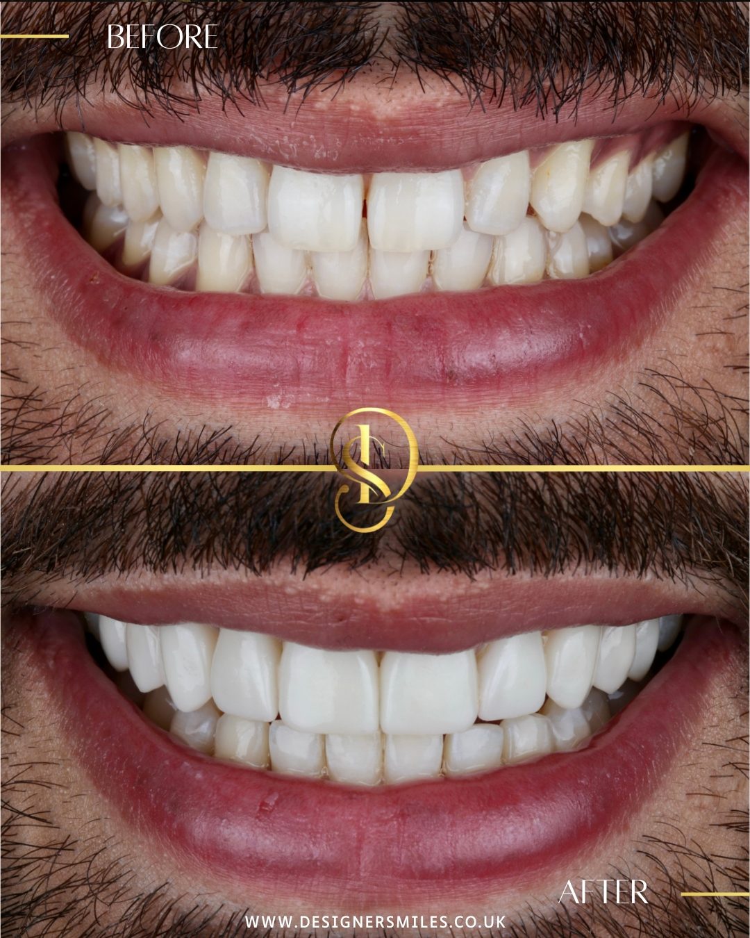 3D composite bonding at Designer Smiles, before and after