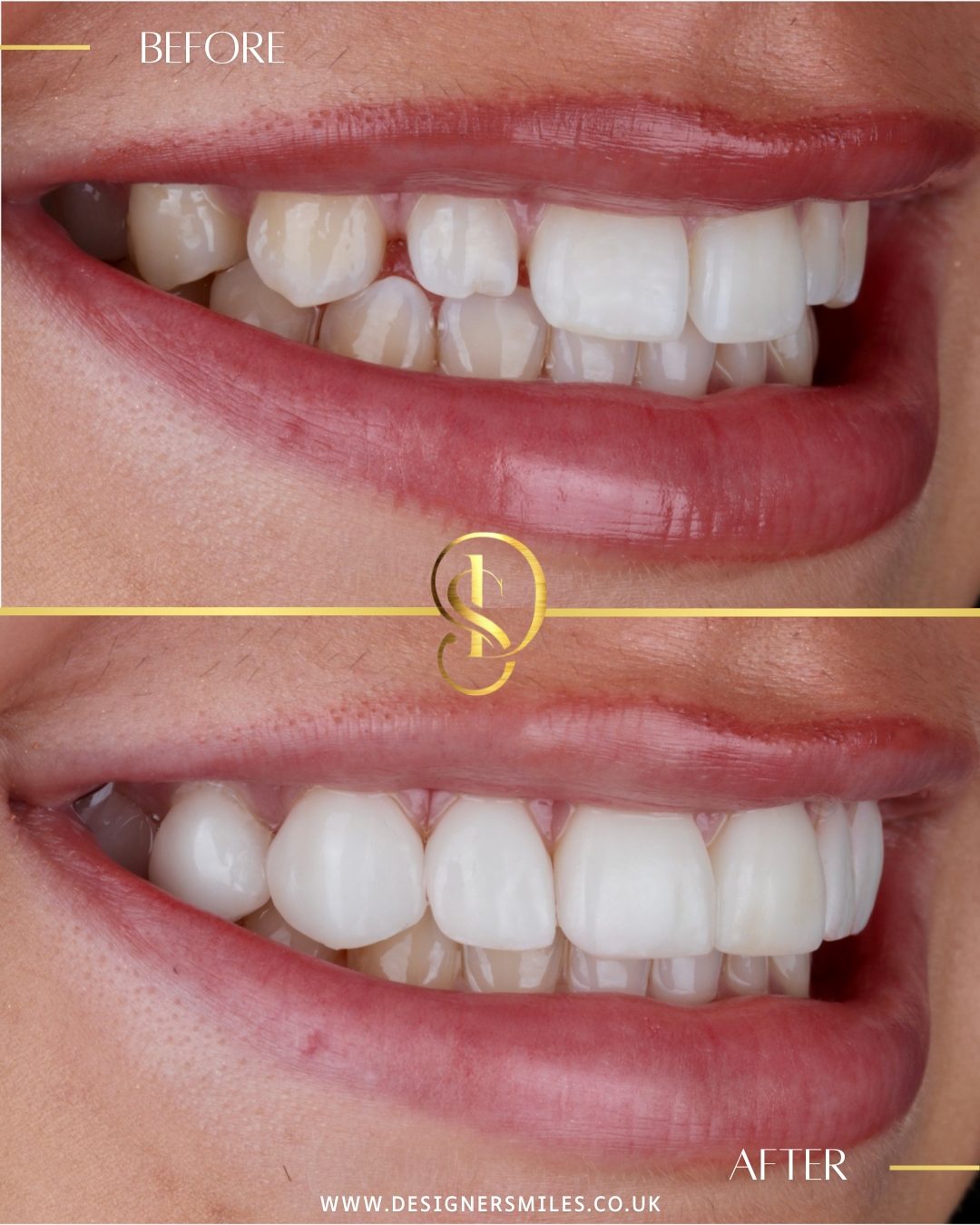 3D composite bonding at Designer Smiles, before and after