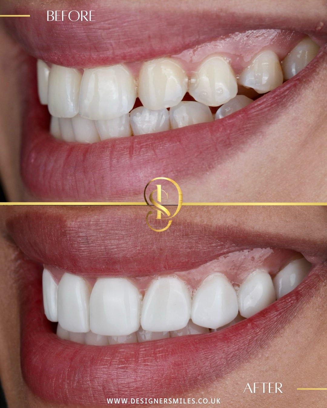 3D composite bonding at Designer Smiles, before and after
