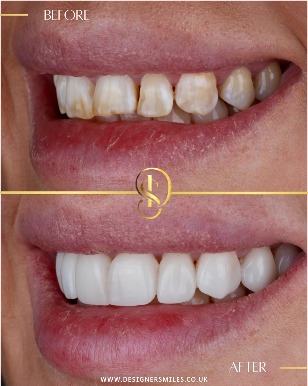 3D composite bonding at Designer Smiles, before and after