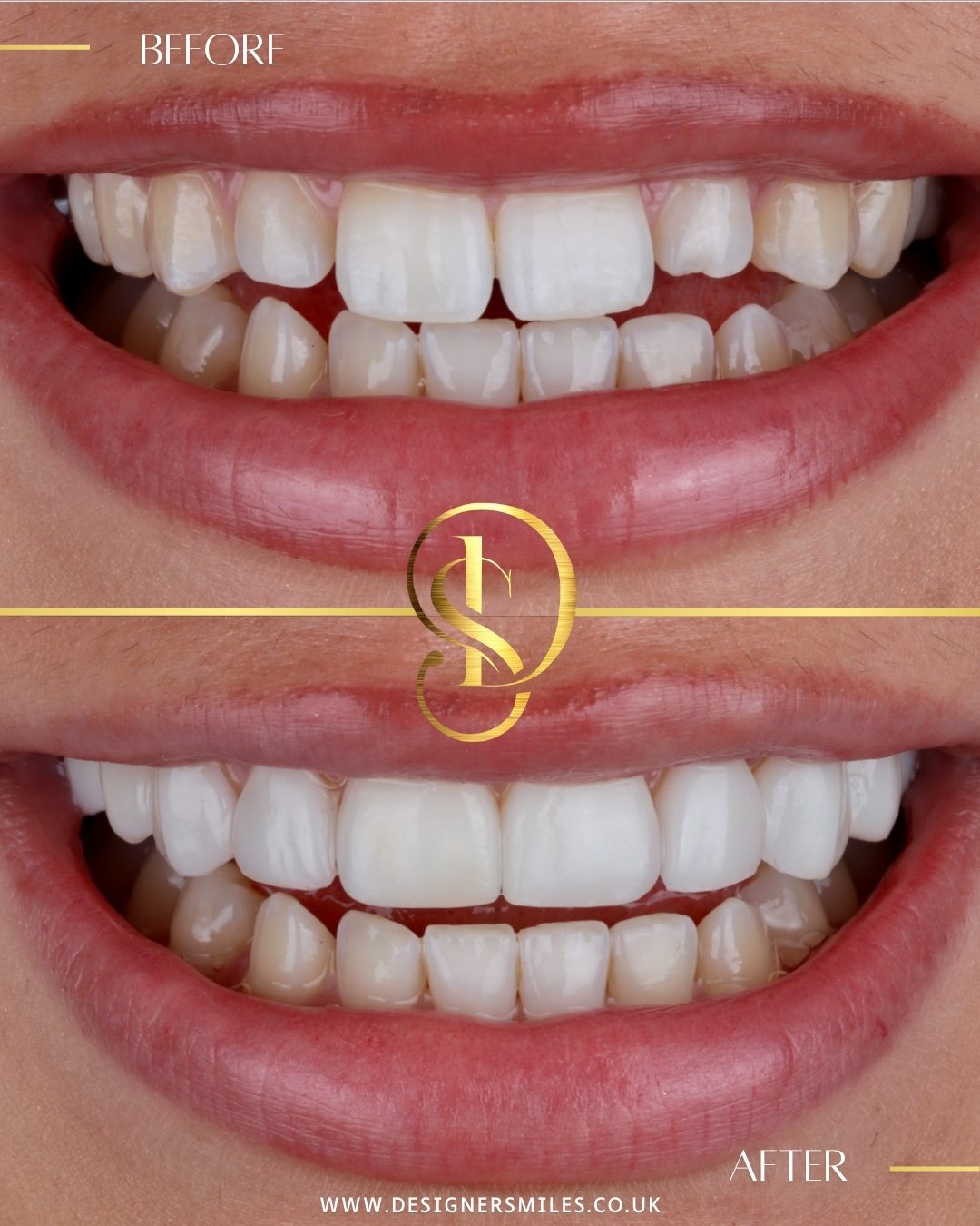 3D composite bonding at Designer Smiles, before and after