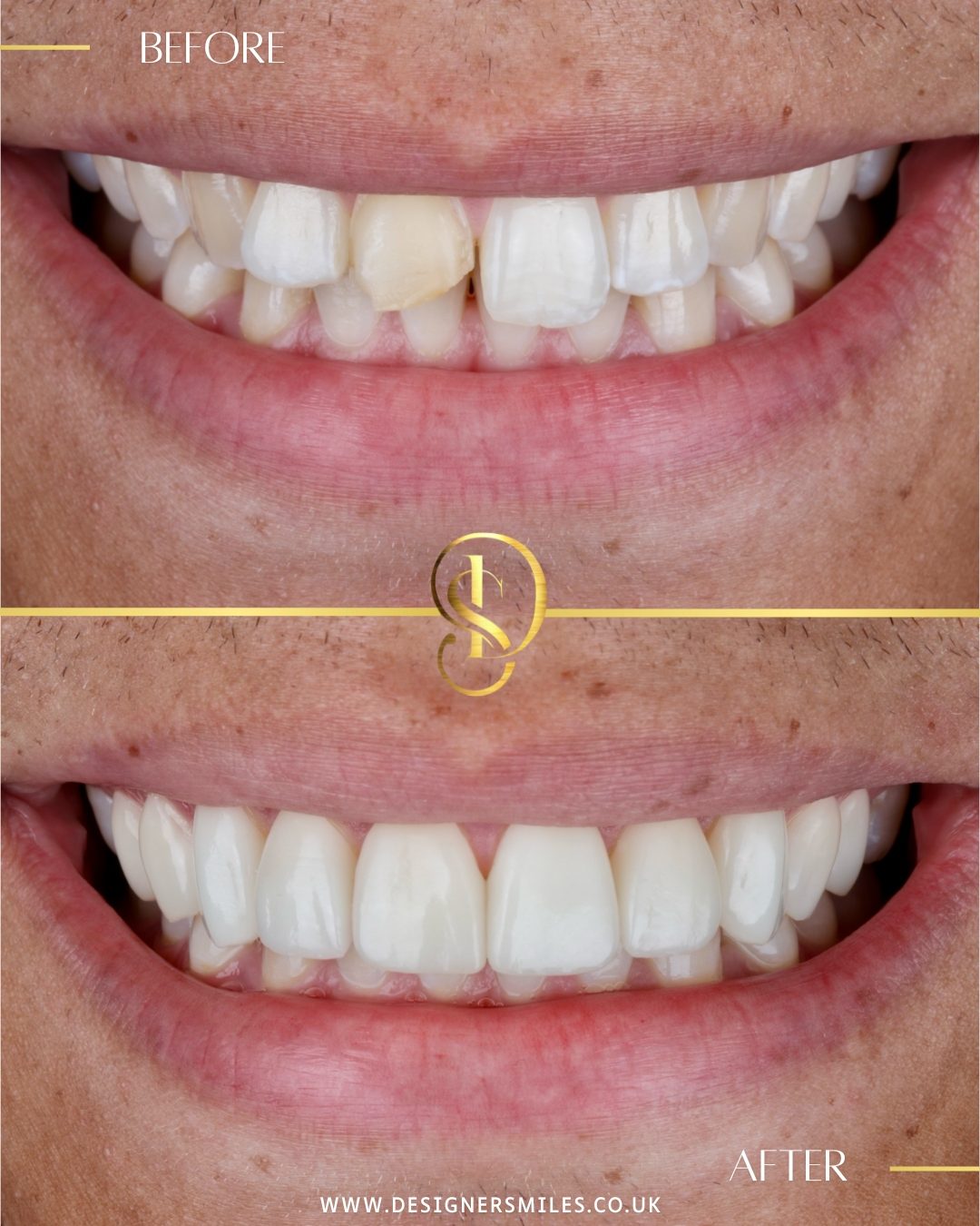3D composite bonding at Designer Smiles, before and after