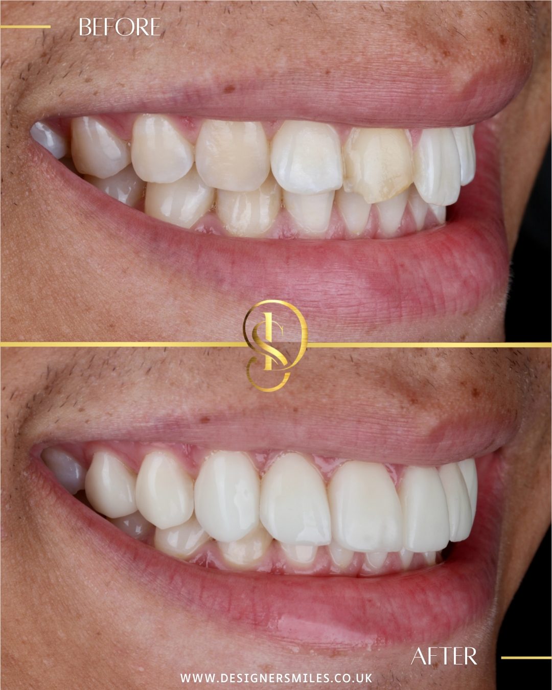 3D composite bonding at Designer Smiles, before and after
