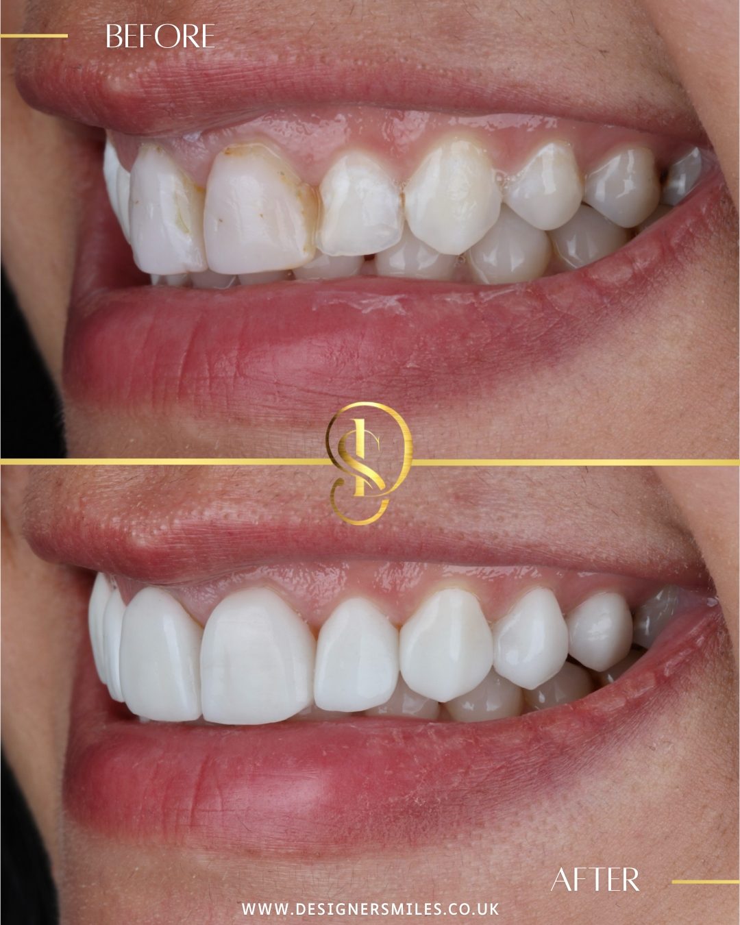 3D composite bonding at Designer Smiles, before and after