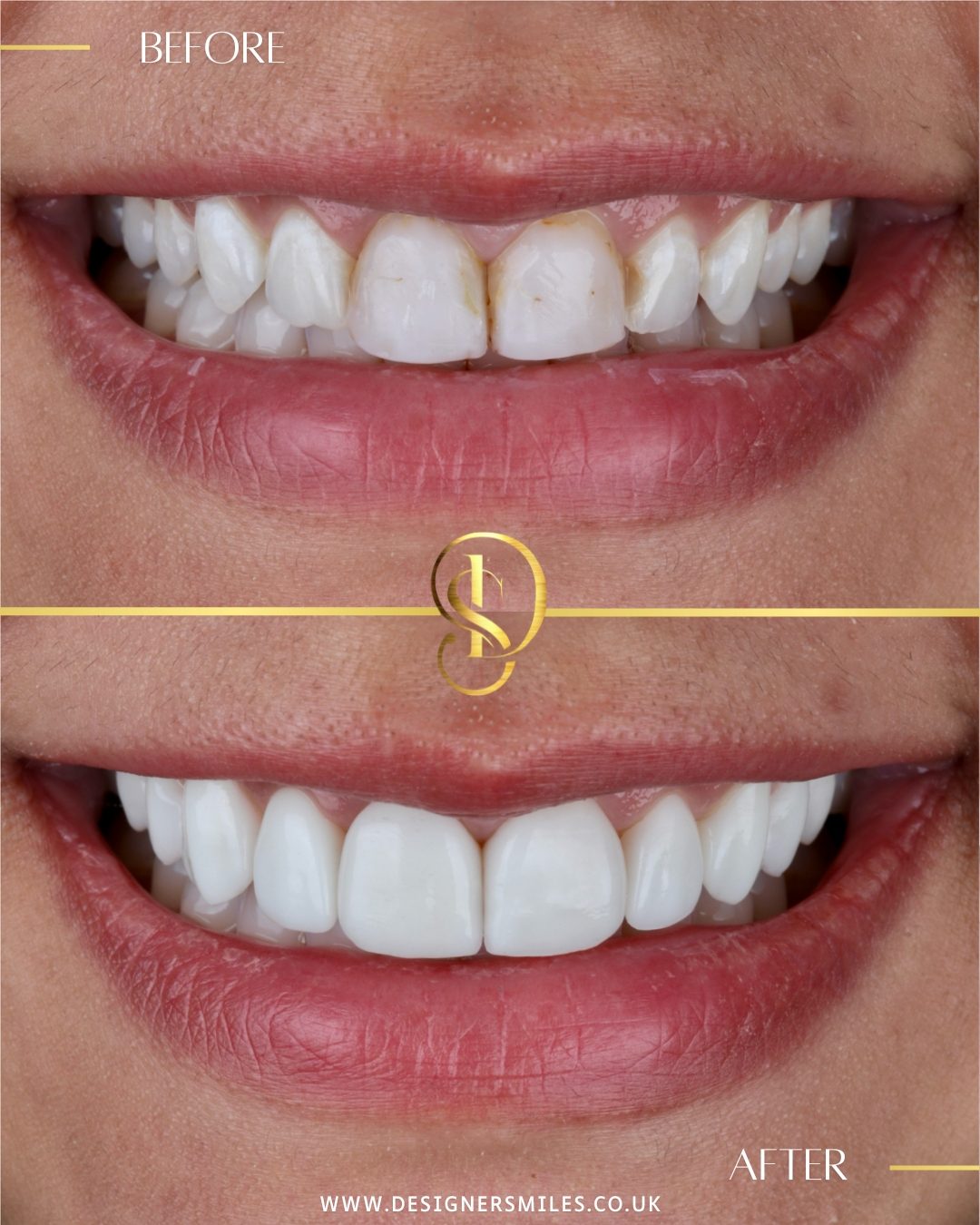 3D composite bonding at Designer Smiles, before and after
