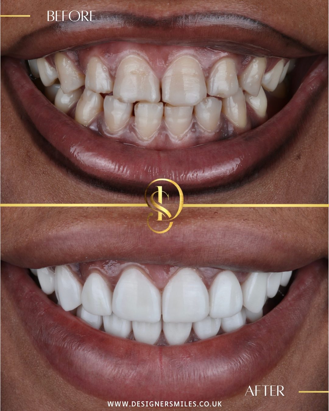 3D composite bonding at Designer Smiles, before and after