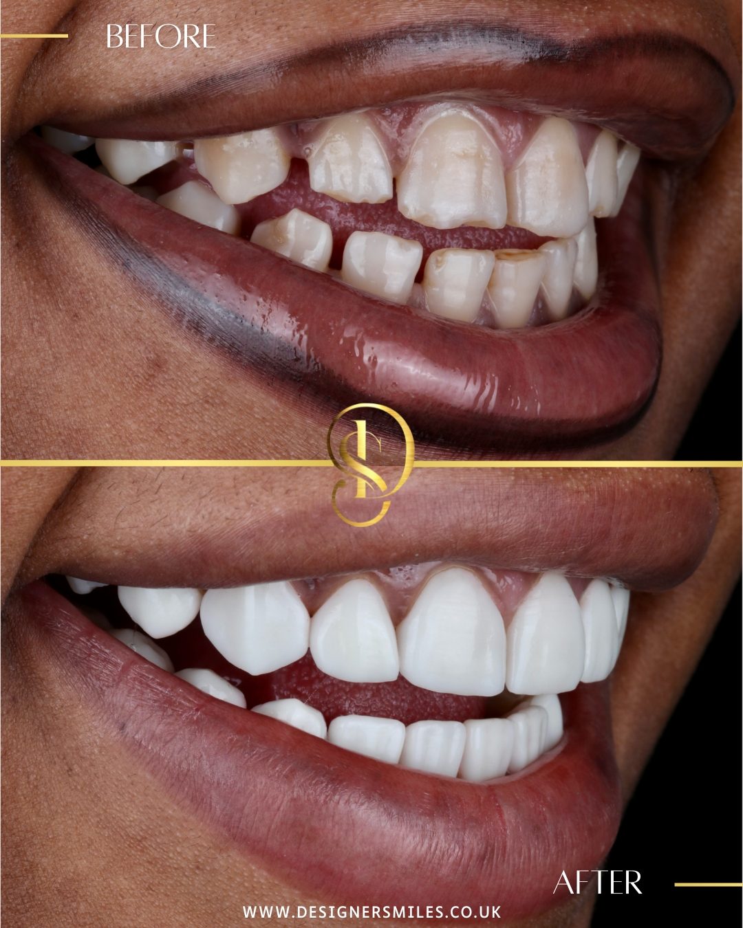 3D composite bonding at Designer Smiles, before and after