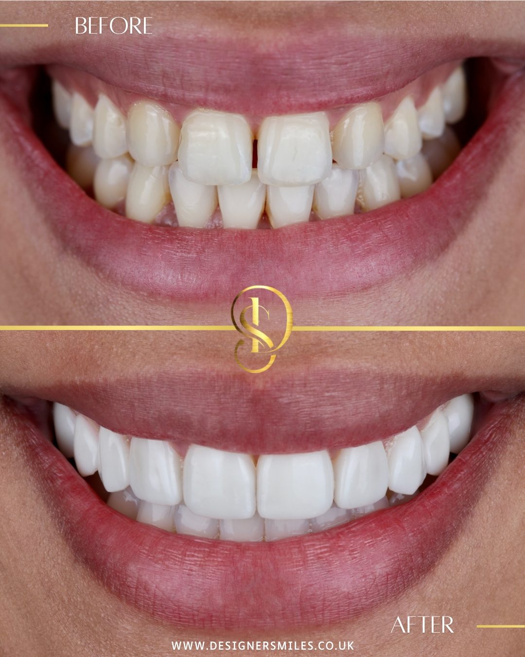 3D composite bonding at Designer Smiles, before and after