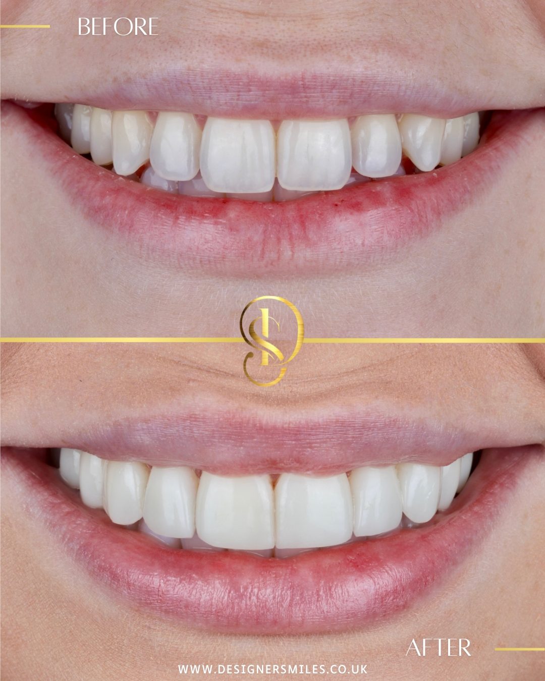 3D composite bonding at Designer Smiles, before and after