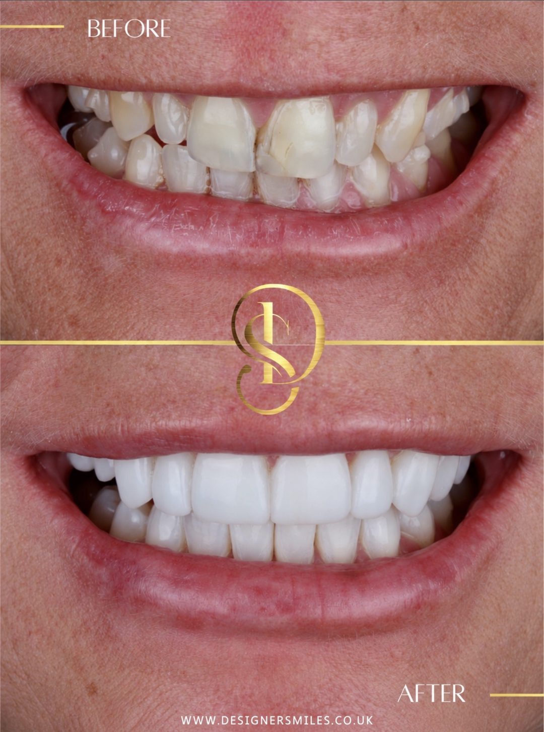 3D composite bonding at Designer Smiles, before and after