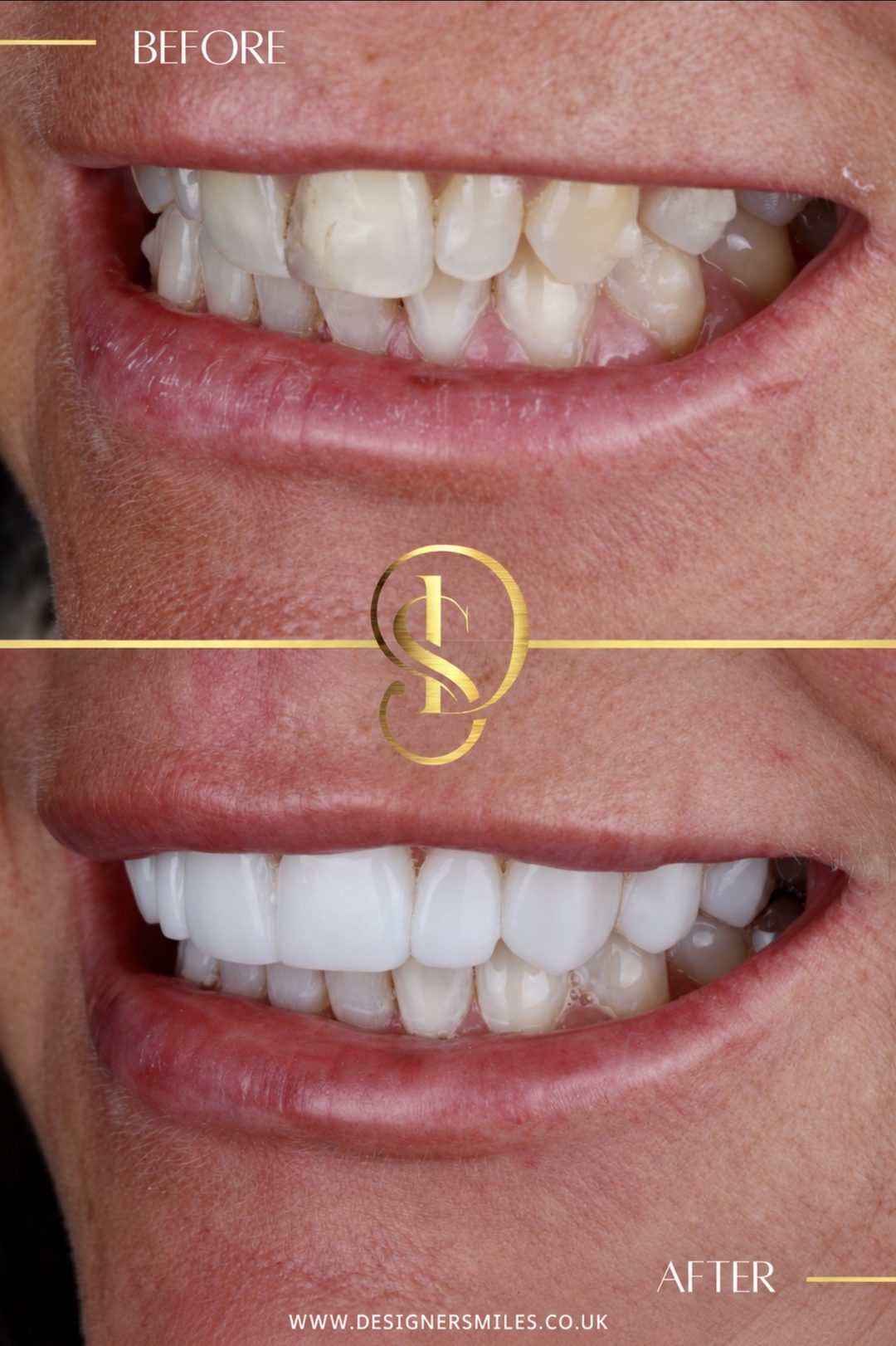 3D composite bonding at Designer Smiles, before and after
