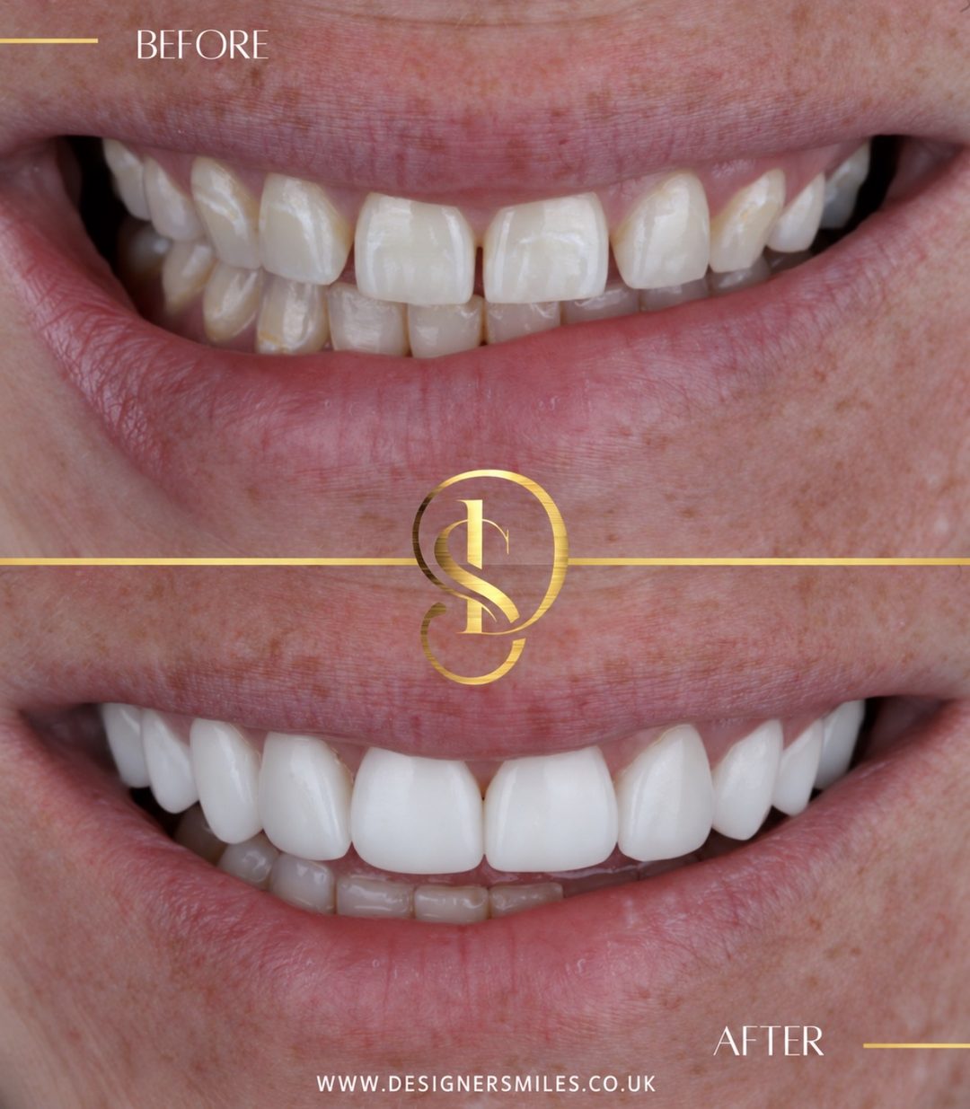 3D composite bonding at Designer Smiles, before and after