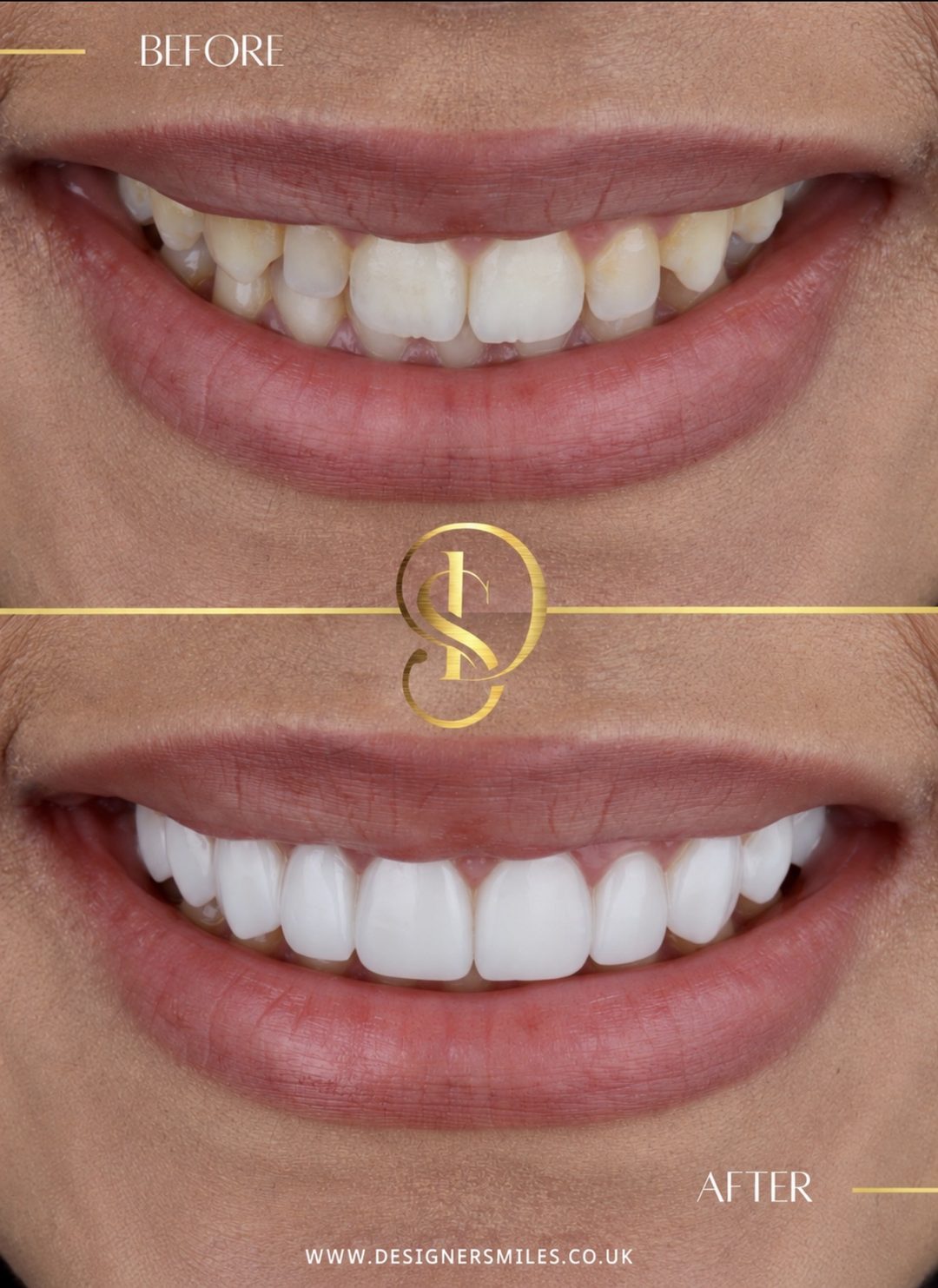 3D composite bonding at Designer Smiles, before and after
