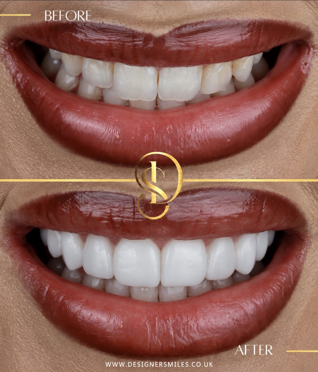 3D composite bonding at Designer Smiles, before and after