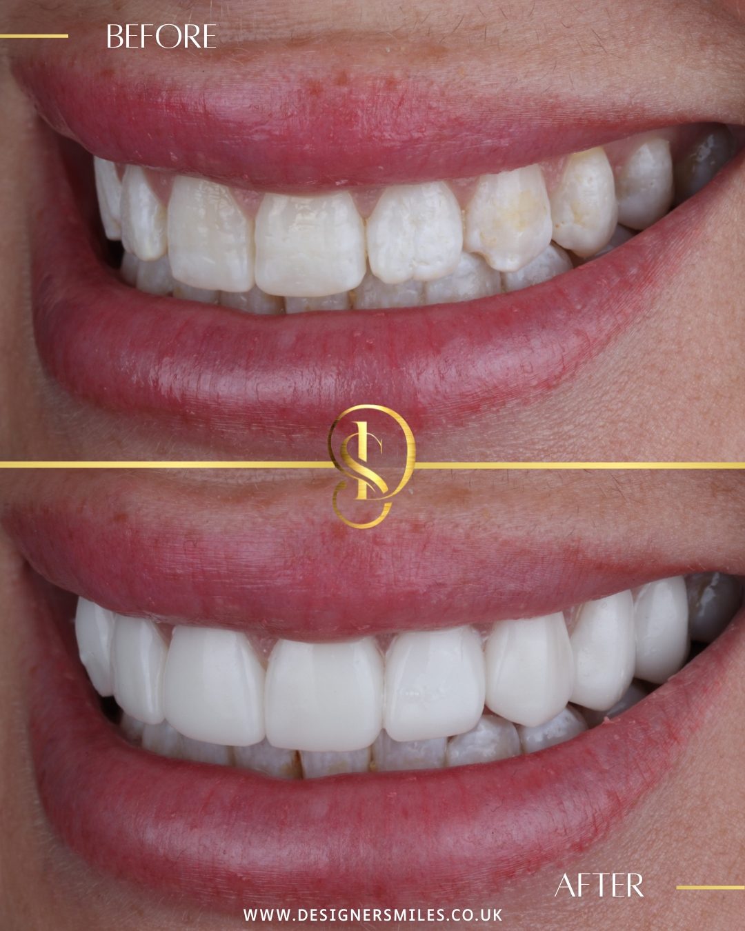 3D composite bonding at Designer Smiles, before and after